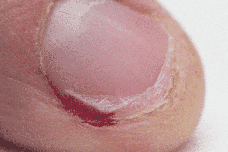 Onychophagie - Qu'est-ce que la dermatophagie ?